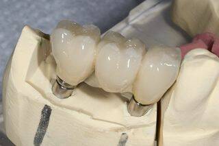 teeth implants